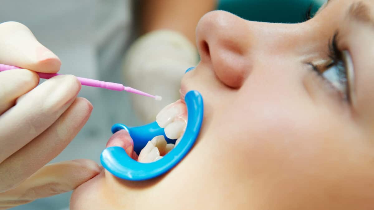 all-about-dental-sealants-and-children-benefits-and-application