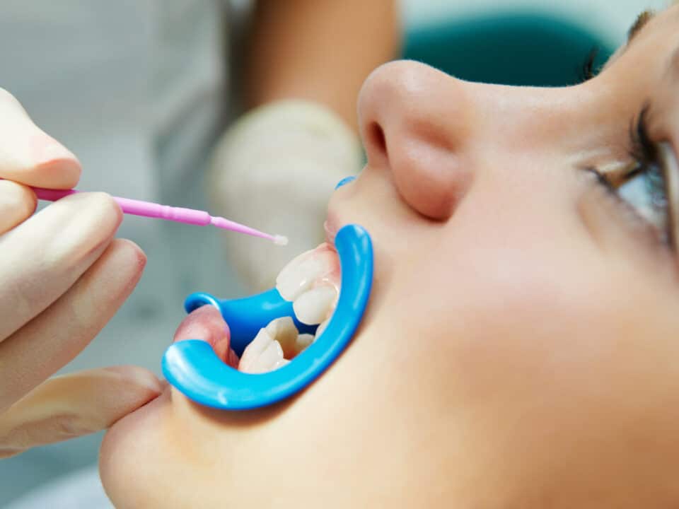 all-about-dental-sealants-and-children-benefits-and-application