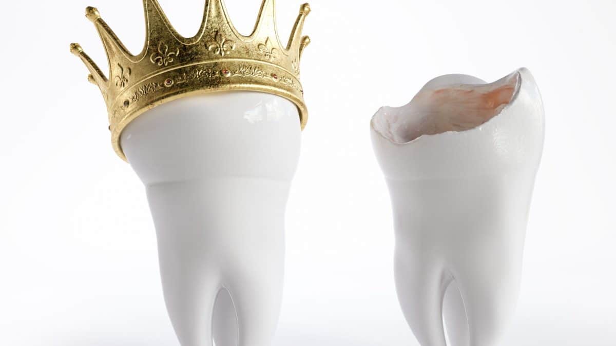dental crown