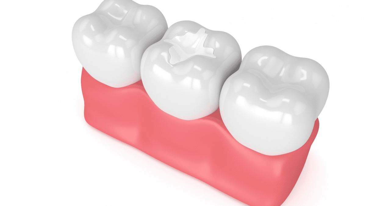 dental sealants