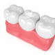 dental sealants