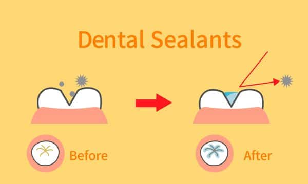 dental sealants