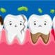 Tooth decay in kids