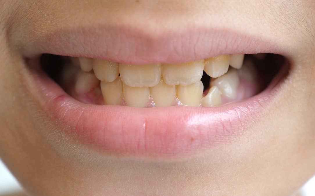 why-a-childs-teeth-may-come-in-yellow-causes-and-prevention-tips