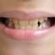 why-a-childs-teeth-may-come-in-yellow-causes-and-prevention-tips